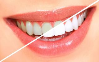 Địa chỉ tẩy trắng răng tốt nhất Long An