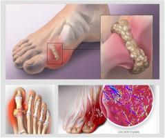 Cách chữa bệnh gout tại nhà hiệu quả nhất nên biết