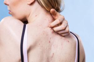 Cách trị mụn ở lưng đơn giản tại nhà