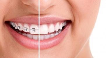 Địa chỉ niềng răng uy tín nhất Quận 11, TP. HCM