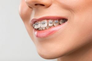 Địa chỉ niềng răng uy tín nhất tỉnh Hà Tĩnh