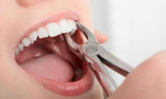 Điều cần làm trước và sau khi nhổ răng