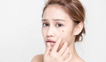 Serum chấm mụn hiệu quả nhất hiện nay