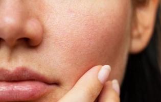 Kem dưỡng se khít lỗ chân lông hiệu quả nhất hiện nay