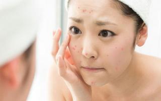 Nguyên nhân dễ gây nổi mụn nhất cho bạn