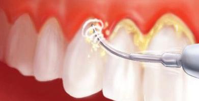 Địa chỉ lấy cao răng tốt nhất tại Đà Nẵng