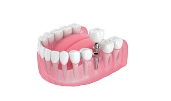 Nha khoa trồng răng implant cho người trung niên tốt nhất tại TP HCM