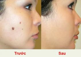 Sản phẩm tẩy nốt ruồi hiệu quả, an toàn nhất hiện nay