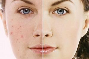 Spa trị mụn hiệu quả nhất Bạc Liêu