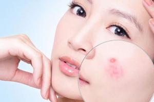 Spa trị mụn hiệu quả nhất ở Cà Mau