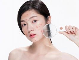Spa trị mụn hiệu quả nhất quận Gò Vấp, TP. HCM