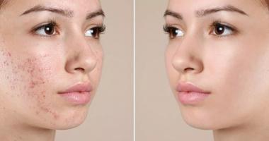 Spa trị mụn hiệu quả nhất quận Tân Bình, TP. HCM