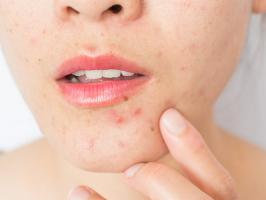 Spa trị mụn hiệu quả nhất Sóc Trăng