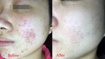 Địa chỉ trị sẹo uy tín và hiệu quả nhất Hà Nội