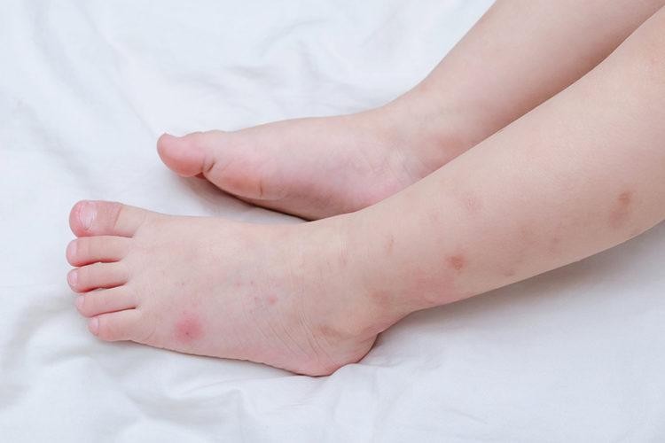 Bôi lăn khủ mùi vào chỗ bị muỗi đốt sẽ tránh bị ngứa