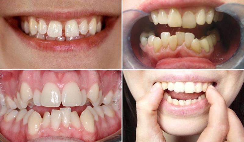 Invisalign là gì và làm thế nào nó khác biệt so với niềng răng truyền thống?