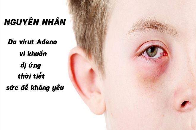 Đau mắt đỏ hay còn gọi là viêm kết mạc