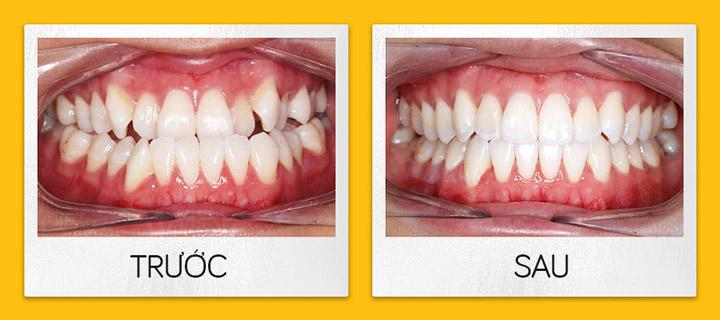 Niềng răng trong suốt Invisalign sau bao lâu thì có kết quả