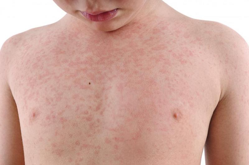 Rubella