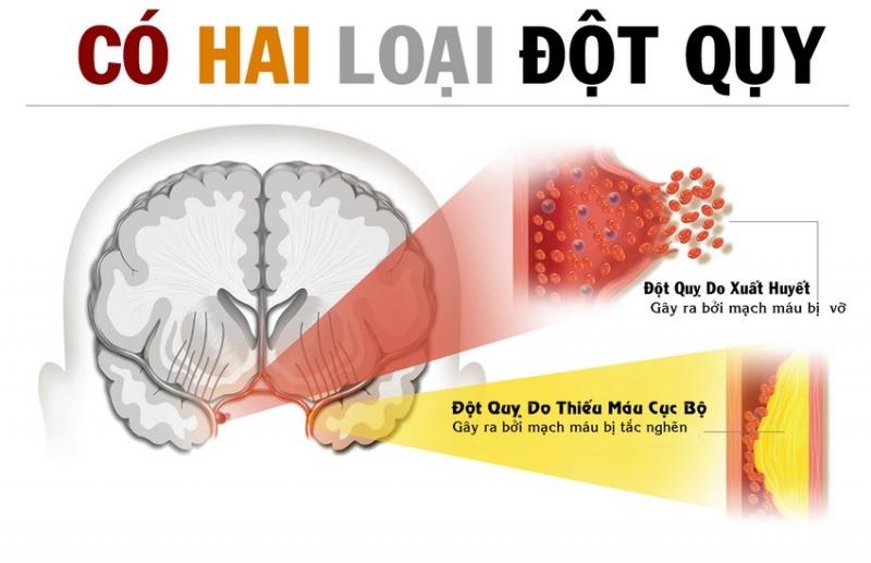 Tai biến mạch máu não (đột quỵ)