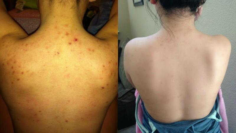 Tạm biệt mụn lưng với dấm táo
